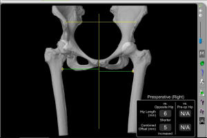 Kalça protezi ameliyatı için Bilgisayarlı Tomografi görüntüleri kullanılarak robot için hazırlanan üç boyutlu görsel. 
