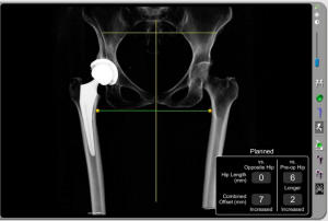 Ameliyat yapılmadan önce bilgisayar yazılımı ile ameliyat sonrası röntgen görüntüsünün nasıl olacağı izlenebilmektedir.