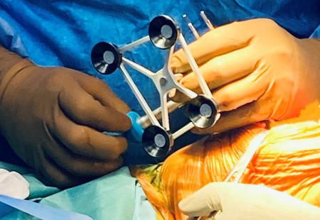 Hastamızın kemiğine sabitlenen array (bilgisayar kamerasının algıladığı optik işaretler) sayesinde kemik ve eklemin konumu ameliyat süresince takip edilmektedir.